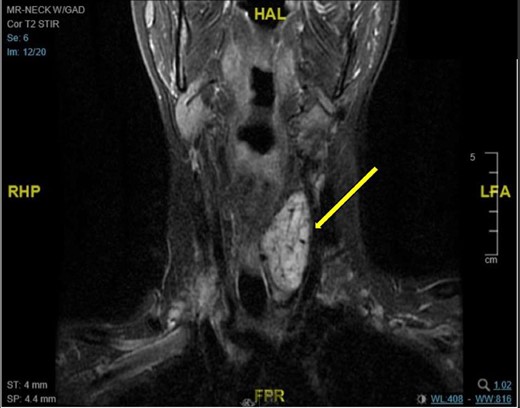 MRI scan of the neck with gadolinium (coronal MRI) demonstrating a mass in the left infrahyoid neck that is 5.6 cm in the maximal craniocaudal dimension, 2.8 cm in the anteroposterior dimension, and 2.4 cm in the mediolateral dimension. The mass is isointense to muscle on the T1-weighted sequence and demonstrates moderate T2 hyperintensity with avid postcontrast enhancement in keeping with a hypervascular mass with arterial supply that arose from the thyroid inferior mesenteric artery and left inferior thyroid artery.