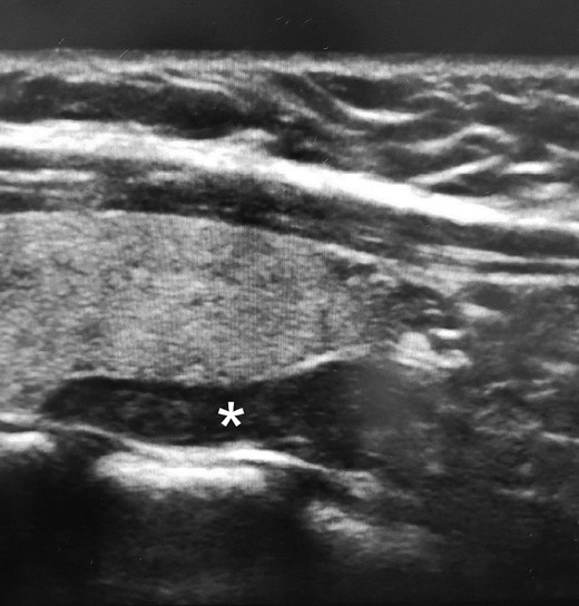 Neck ultrasound images showing an elongated hypoechoic nodule (*) measuring 1.8 × .6 × 1.0 cm posterior to and separate from the left thyroid lobe.