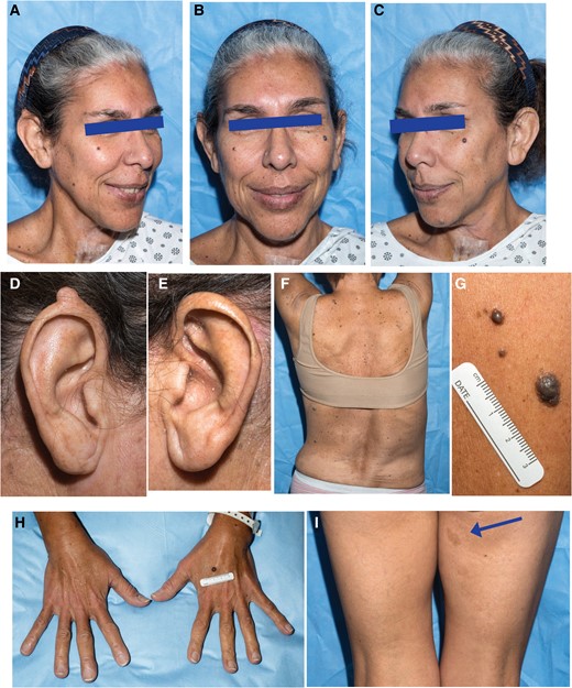Facial features and other physical findings in a patient with primary hyperparathyroidism and germline missense p.R764W ZFX variant. A to C, Facial features demonstrating long, oval-shaped face, thick eyebrows, long philtrum, long tubular nose, pointed chin, long ears, melanocytic facial nevi, and macules involving the lower vermilion lip. D and E, Close-up of ears showing skin-colored nodule on superior helix of the right ear. F, Posterior view of thorax demonstrating spinal scoliosis. G, Close-up view of multiple raised melanocytic nevi. H, Dorsal view of hands showing elongated fingers. I. Posterior view of thighs, showing café-au-lait macule on right medial thigh (arrow).