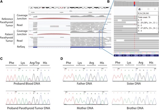 Results of RNA sequencing (RNAseq) analysis of parathyroid tumor and DNA sequencing of patient and family samples. A, The Integrative Genomics Viewer (IGV) view of RNAseq analysis of parathyroid tumor transcripts. Binary alignment map files were viewed in the IGV browser showing parathyroid tumor samples with reference sequence (parathyroid tumor from unrelated patient) or variant sequence (the patient's excised parathyroid tumor) in the ZFX gene. RNAseq analysis employed polyA selection, a total of 22.9 million 150-bp paired-end reads, and 22.0 million reads aligned, with Illumina sequencing by Quick Biology. B, Expanded detail from IGV view of the RNAseq analysis that reveals a missense variant in the ZFX gene (ZFX: NM_003410.4:exon10: c.2290C > T:p.R764W) with a variant allele frequency of 62% in the RNA. C, Sanger sequencing of proband (patient) leukocyte (upper) and parathyroid tumor (lower) DNA samples as chromatographic traces with signal intensity, in relative fluorescence units, and bases assigned as shown. Both tracings show presence of heterozygous missense p.R764W ZFX variant. D, Results of Sanger sequencing of parent and sibling blood DNA showing absence of the p.R764 ZFX variant.