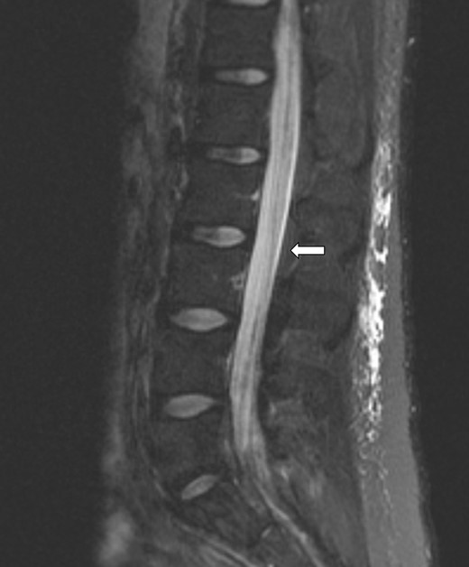 Extensive nodular enhancement involving the leptomeninges of the lumbar spine (arrow) as well as lumbar cauda equina nerve roots involvement.