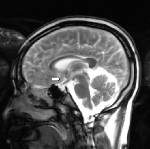 Brain magnetic resonance imaging with numerous small nodular enhancement involving leptomeninges and cerebrospinal fluid space supratentorially and infratentorially, pituitary stalk (arrow), interpeduncular cistern, and periaqueductal perivascular space.