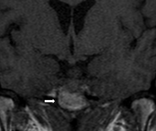 Magnetic resonance imaging of the brain: 1.8 cm sellar mass (arrow) causing deviation of the optic chiasm.