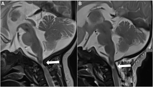 (A) Preoperative brain MRI at the age of 2 months. Sagittal T2-weighted image demonstrates high-grade stenosis of the foramen magnum with compression and myelopathy of the upper cervical spinal cord (arrow). (B) Brain MRI 3 days after decompression surgery. Sagittal T2-weighted image demonstrates a moderately enlarged foramen magnum with a partially unfolded upper cervical spinal cord but remaining signs of short segment cervical myelopathy (arrow). Abbreviations: MRI, magnetic resonance imaging.