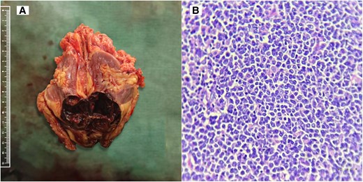 (A) Nephrectomy specimen showing macroscopic tumor appearance. (B) High-power view with 400× magnification (scale bar = 100 µm) showing small to medium-sized lymphoid cells arranged in a nested pattern with amphophilic cytoplasm, irregular nuclear membrane, vesicular nuclear chromatin, prominent nucleoli, and mitotic figures.