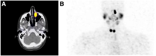 Diagnostic scan with 123-Iodine. A shows the SPECT-CT scan demonstrating increased iodine uptake in the medial portion of the patient's left orbit. B shows the whole-body iodine scan. This scan demonstrates the physiological uptake of the salivary gland and remnant thyroid as well as the irregularity of iodine uptake in the left orbit.