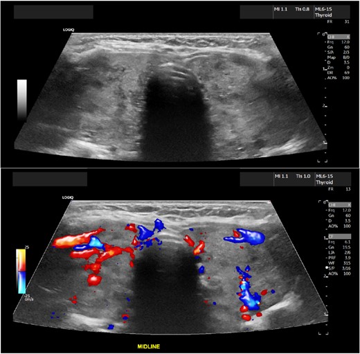 Enlarged heterogeneous, hypervascular thyroid gland with the right lobe being 6.9 × 2.6 × 2.8 cm and the left lobe being 6.8 × 3.1 × 2.8 cm.