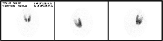 Uniformly increased tracer uptake in enlarged thyroid gland on radioactive iodine uptake while hyperthyroid on methimazole 80 mg daily without hypo/hyperfunctional nodules. The 6-hour RAIU was 20% (reference range 5-15%), and the 24-hour RAIU was 26% (reference range 10-30%).