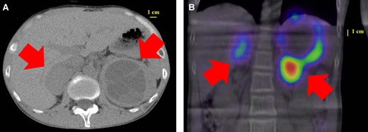 Images of CT and 123I-MIBG scintigraphy. The abdominal CT scan showed bilateral adrenal masses with a low-density area inside (A). 123I-MIBG scintigraphy showed accumulation consistent with the CT image (B). The arrows indicate the adrenal masses.
