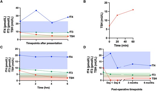 Thyroid function. (A) Free thyroid hormones (fT4 in blue, fT3 in green) and TSH (in red) concentrations at various timepoints following presentation. The shaded areas represent the normal reference range for each hormone (fT4 in blue, fT3 in green, TSH in red). (B) TSH concentrations at baseline and 20 and 60 minutes following stimulation with thyrotropin-releasing hormone (TRH, 200 μg, IV). C, Free thyroid hormones (fT4 in blue, fT3 in green) and TSH (in red) concentrations at baseline and at 2, 4, and 6 hours following administration of octreotide (100 μg, SC). The shaded areas represent the normal reference range for each hormone (fT4 in blue, fT3 in green, TSH in red). D, Free thyroid hormones (fT4 in blue, fT3 in green) and TSH (in red) concentrations following endoscopic resection of nasopharyngeal lesion. The shaded areas represent the normal reference range for each hormone (fT4 in blue, fT3 in green, TSH in red).