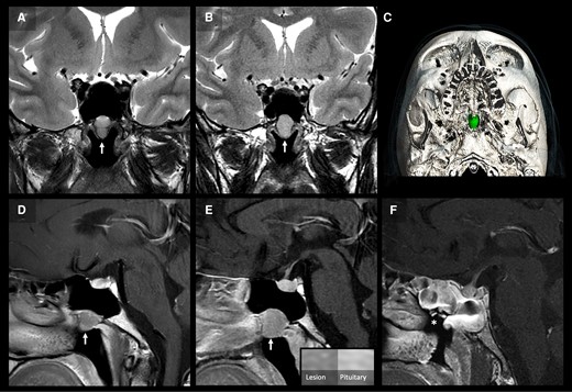 Pituitary imaging. Two serial coronal T2-weighted (A, B) and postcontrast sagittal T1-weighted (D, E) MRI images of the pituitary at presentation (A, D), and 4 years later (B, E) demonstrate a slow-growing ovoid lesion in the bony floor of the paranasal sphenoid sinus projecting into the nasopharynx. The lesion exhibits homogenous, moderately high, T2-weighted signal and adenoma-like enhancement, less than the normal pituitary (E). 3D-reconstruction of the operative planning CT (C) with segmentation of the lesion (green) shows smooth remodeling and scalloping of the surrounding bone. Postoperative postcontrast sagittal T1-weighted MRI (F) shows complete resection of the lesion (asterisk in surgical cavity) and expected postsurgical mucosal edema in the adjacent sphenoid sinus.