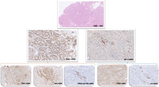 Pathological and immunohistochemical staining results of nasopharyngeal tissue. Histopathological findings (stains and magnification as labeled): Hematoxylin and eosin staining shows pituitary adenoma with tumor cells arranged predominantly in an acinar pattern with focal perivascular pseudorosettes. On immunohistochemistry the tumor cells show widespread strong nuclear labeling for Pit-1 along with focal nuclear staining for SF-1. Tumor shows patchy cytoplasmic expression for TSH, GH, and prolactin. There is widespread cytoplasmic staining for FSH while LH expression is seen in a few tumor cells.