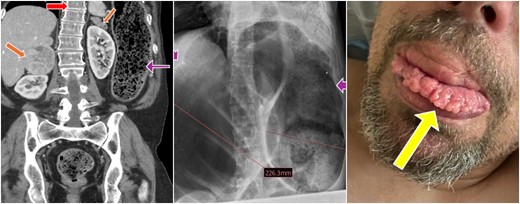 CT scan of the abdomen shows bilateral adrenal masses, lateral scoliosis and dilated colon on abdomen X-ray & mucosal neuromas on the tongue.