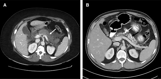 A, Computed tomography of the abdomen depicting necrotizing pancreatitis during an episode of acute abdominal pain in the proband (mother). B, Follow-up imaging shows dilated pancreatic duct (white arrow), multiple intraductal calculi, and parenchymal calcification (black arrow) with marked atrophy of the gland.