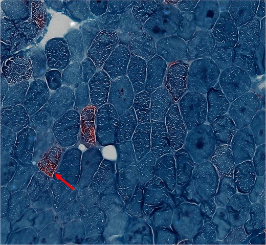 Cross sections of skeletal muscle with scattered ragged red fibers in the proband's daughter (modified gomori trichrome stain ×400).