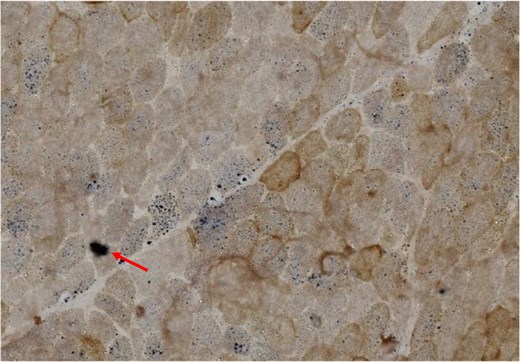 Cross sections of skeletal muscle from the proband's daughter. It demonstrates several scattered cytochrome oxidase–deficient fibers that are highlighted by succinic dehydrogenase (COX-SDH ×400).