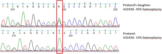 Sanger sequencing showing A3243G hotspot mutation in heterozygous state.