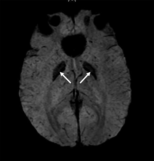 Magnetic resonance susceptibility weighted imaging (SWI) sequence of the brain of the proband’s daughter showing the globus pallidi blooming (arrow).