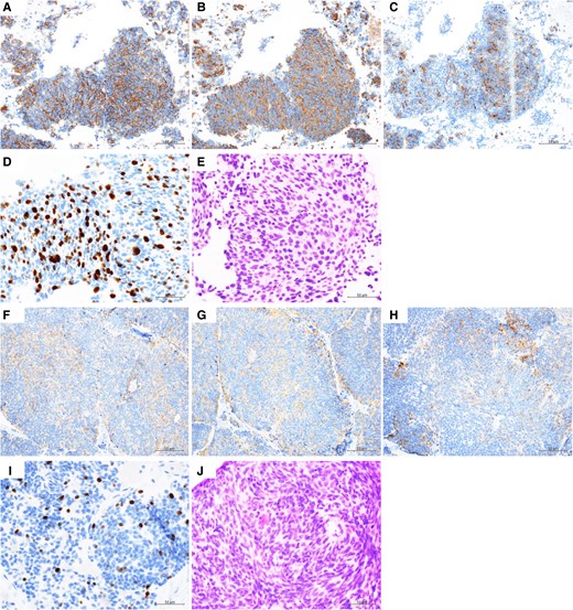 Immunohistochemical staining of the mediastinal lymph node and the scalp. The mediastinal lymph node (A-E) and the scalp (F-J) were investigated by immunohistochemical staining: CD56 (A, F), synaptophysin (B, G), and chromogranin A (C, H). The Ki-67 proliferation index in hot spots was 50% in the mediastinal lymph node and 11% in the scalp (D, I). The mitotic rate was >20/10 high power field in the mediastinal lymph node and 12/10 high power field in the scalp (E, J).