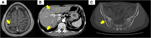 Imaging studies of metastasis in the brain, the lung, and the bone. (A) Magnetic resonance imaging of the brain showed a 12-mm ring-shaped contrast-enhanced mass in the right parietal lobe. (B) Contrast-enhanced computed tomography (CT) of the abdomen showed multiple masses within the liver. (C) CT of the iliac bone showed osteolytic changes. Permission for the use of the CT image has already been obtained from another hospital.