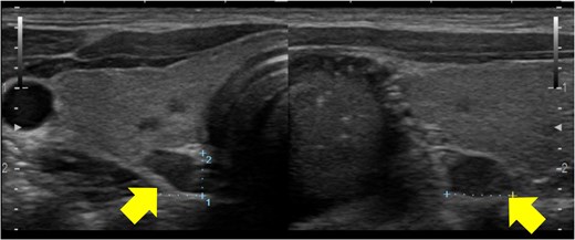 Ultrasonography of the parathyroid glands. Ultrasonography showed enlargement of all parathyroid glands.