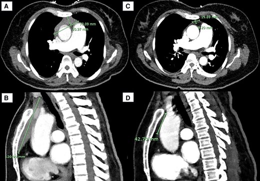 Anterior mediastinal mass (AMM) on computed tomography (CT) of the chest in A, transverse and B, sagittal views on admission to our service, 1 month following onset of Graves disease treatment. Interval CT chest in C, transverse and D, sagittal views 1 year after initial imaging, demonstrating regression of the thymic mass.