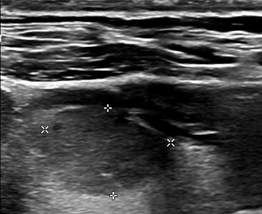 ALT TEXT: Neck ultrasound image showing a 1.1 × 1.5 × 1.9 cm nodule in the right thyroid lobe. The nodule is solid and hypoechoic, has a wider-than-tall shape, smooth margins, and no echogenic foci. It scores 4 points according to the ACR TI-RADS, classifying it as TI-RADS 4.