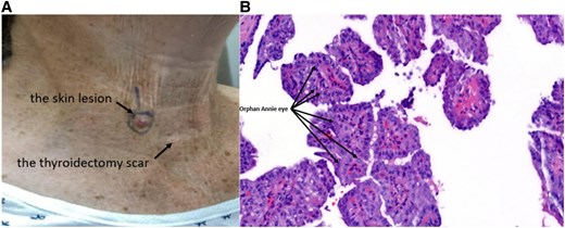 ALT TEXT: Photograph of a solitary, well-circumscribed, raised, erythematous, dome-shaped lesion on the anterior lower neck above the total thyroidectomy scar, measuring approximately 0.8 centimeters in diameter. Accompanying this is a histopathology image stained with hematoxylin and eosin, which shows tumor cells arranged in papillary structures with fibrovascular cores. The cells display characteristic features including enlarged nuclei with cleared chromatin (“Orphan Annie eye” nuclei), nuclear grooves, and occasional intranuclear inclusions, confirming the diagnosis of metastatic papillary thyroid carcinoma.