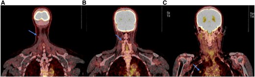 ALT TEXT: Positron emission tomography/computed tomography images from the skull to mid-thigh demonstrating hypermetabolic activity in three regions: (A) a cutaneous lesion in the right anterior lower neck (indicated by an arrow), (B) an adjacent lymph node in the right anterior lower neck (indicated by an arrow), and (C) a nodule in the right upper lobe of the lung (indicated by an arrow).