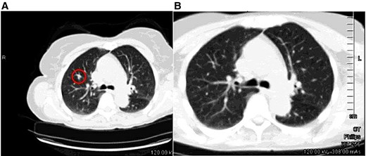 ALT TEXT: Side-by-side computed tomography (CT) images of the right upper lobe of the lung. Image A shows a previously detected nodule (circled), while image B from a follow-up CT scan shows that the nodule is no longer visible, indicating resolution of the lesion.