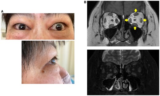 Graves ophthalmopathy in the patient. A, Frontal and lateral views of the patient's eyes. B, Orbital magnetic resonance imaging in T1-weighted (upper panel) and fat-suppressed T2-weighted (lower panel) imaging. Arrows show diffuse enlargement of the external ocular muscles.