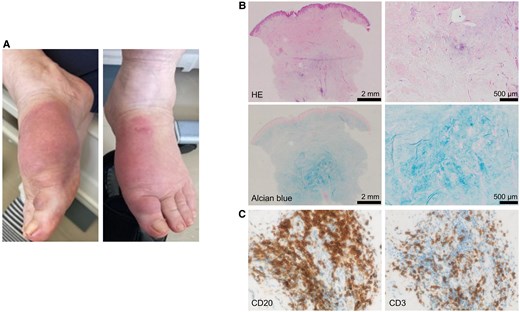 Pretibial myxedema (PTM) in the patient. A, Physical findings on the dorsum of both feet. B, Hematoxylin and eosin (HE) staining (upper panels) and alcian blue staining (lower panels) of PTM tissue at low magnification (left panels) and high magnification (right panels). C, CD20 staining (left panel) and CD3 staining (right panel) of PTM tissue.