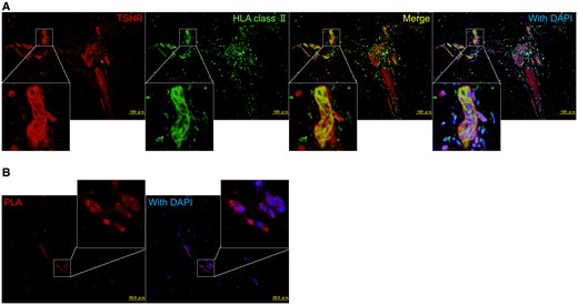 Immunohistological analysis of the pretibial myxedema (PTM) tissues in the patient. A, Immunostaining of thyrotropin receptors (TSHRs) and human leukocyte antigen (HLA) class II (DR + DQ + DP) in PTM tissues. Formaldehyde-fixed and paraffin-embedded sections of the PTM biopsy tissues were incubated with rabbit anti-TSHR polyclonal (HPA026680, Sigma-Aldrich) and mouse anti-HLA class II (DR + DQ + DP) monoclonal (ab7856, Abcam) antibodies as primary antibodies. These were followed by Alexa Fluor 594–conjugated anti-rabbit immunoglobulin G (IgG) antibodies (Molecular Probes) and biotinylated anti-mouse IgG antibodies (Vector Laboratories) as secondary antibodies, with Alexa Fluor 488–conjugated streptavidin (Life Technologies). B, Proximity ligation assay (PLA) using a Duolink in situ PLA kit (Sigma-Aldrich) in the PTM tissues. Sections of PTM biopsy tissues were incubated with rabbit anti-TSHR and mouse anti-HLA class II (DR + DQ + DP) antibodies. PLA signals were visualized as red fluorescent protein signals using anti-rabbit PLUS and anti-mouse MINUS PLA probes.