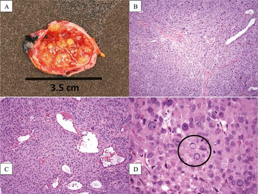 (A) Gross cross-sectional appearance of the resected ovary, showing a smooth outer capsule surrounding a yellow, fleshy, lobulated, and partially cystic/hemorrhagic mass replacing the normal ovarian parenchyma. (B) 100× magnification showing large nodules of tumor separated by distinct fibrous bands. (C) 200× magnification showing that the tumor nodules are composed of solid sheets of epithelioid tumor cells resembling primitive granulosa cells. (D) 600× magnification showing that the tumor cells contain round to ovoid nuclei with prominent nucleoli and occasional nuclear pseudoinclusions (circled).