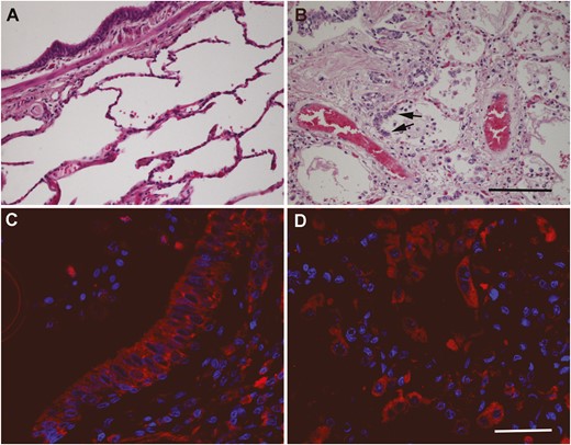 Representative microphotographs of the lung of non-COVID-19 (A) and of SARS-CoV-2-positive samples (B-D). Hematoxylin-eosin stained sections (A and B) show clear histological changes caused by SARS-CoV-2 infection, including proliferation of type II pneumocytes (arrows in B). Immunofluorescence for RAMP1 shows the distribution of this receptor component in the bronchiolar epithelium (C) and the hyperplastic type II pneumocytes (D) in SARS-CoV-2 samples. Scale bar for A and B = 200 µm. Scale bar for C and D = 50 µm.