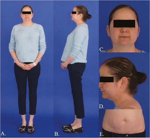 Clinical features of Cushing syndrome. A, B, Central obesity with proximal muscle wasting; C, Bitemporal fat pads, facial rounding, acne, lanugo; D, Dorsocervical and supraclavicular fat deposition, alopecia; E, Wide, though faint, abdominal striae.