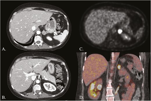 Adrenal imaging. A, Computed tomography (CT) of the adrenal glands with intravenous contrast showing left micronodular adrenal hyperplasia with an adenoma; B, CT adrenal glands with intravenous contrast demonstrating right micronodular adrenal hyperplasia; C, Axial view of 18F-fluorodeoxyglucose (18F-FDG) positron emission tomography (PET) showing an abnormally hypermetabolic left adrenal mass; D, Coronal view of 18F-FDG PET fused to CT without intravenous contrast, showing the hypermetabolic left adrenal mass.