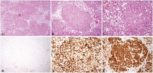 Left adrenal gland pathology consistent with primary pigmented nodular adrenocortical hyperplasia with a macronodule. A, Left adrenal gland. Scanning magnification view shows multiple well-circumscribed unencapsulated hyperplastic adrenocortical nodules composed of large epithelioid cells with abundant eosinophilic cytoplasm partially separated by adrenocortical cells with pale staining cytoplasm (hematoxylin and eosin staining, 4× original magnification); B, Left adrenal gland hematoxylin. Intermediate magnification view shows one of the hyperplastic nodules composed of large epithelioid cells with abundant eosinophilic cytoplasm and surrounding adrenocortical cells with pale staining cytoplasm (hematoxylin and eosin staining, 10× original magnification); C, Left adrenal gland. High magnification view revealed intracytoplasmic melanin pigments within large epithelioid cells of hyperplastic nodule (hematoxylin and eosin staining, 4× original magnification); D, Left adrenal gland. Lesional cells of the hyperplastic nodule are mostly negative for HMB-45. The adjacent adrenal cortical epithelium shows focal weak staining by HMB-45 immunohistochemistry, ×10 magnification; E, Left adrenal gland. Lesional cells of the hyperplastic nodule show strong cytoplasmic staining by melan-A immunohistochemistry, 10× original magnification; F, Left adrenal gland. Lesional cells of the hyperplastic nodule show strong and diffuse staining by synaptophysin immunohistochemistry, 10× original magnification.