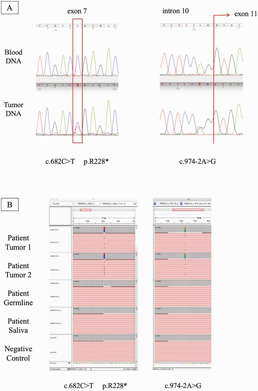 PRKAR1A DNA analysis. A, Electropherogram showing the 2 PRKAR1A variants found in the DNA extracted from the patient’s adrenocortical adenoma. Red rectangles show the location of the mutation; B, Integrative genome viewer (IGV) raw data analysis showing the presence of the variant in high frequency only at the tumor level.