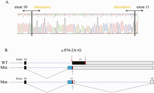 PRKAR1A RNA splice analysis. A, c.974-2A>G was identified at the cDNA level where a new acceptor site was created before the regular one. The presence of this change generated a new acceptor site 67 bases before the beginning of the normal exon 11; B, This new sequence created a new exon 12.