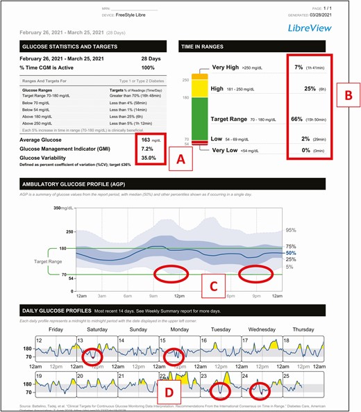 Case example. Patient history: 80-year-old female with T1D treated with MDI therapy.