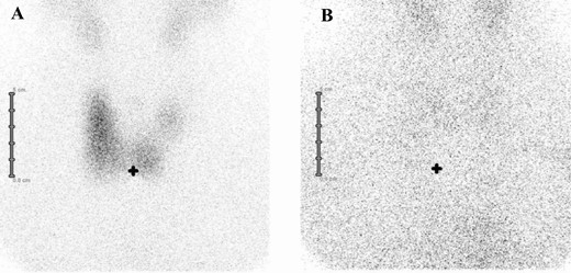 A, Formation of a scintigraphy image due to a normal/increased uptake of technetium (Sci+). B, Absent formation of a scintigraphy image due to an absent uptake of technetium (Sci–). In both patients neck ultrasound showed diffuse goiter.