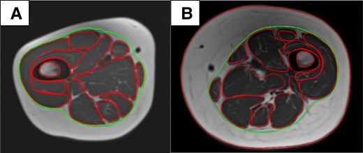 A, TD child; age 11 years. B, XLH child; age 10 years. Measurement of IMAT by manual tracing of the deep fascia at mid-thigh level. Green: deep fascia; red: external contour of the muscle. The inner and outer cortex were also traced. IMAT, intermuscular adipose tissue; TD, typically developing; XLH, X-linked hypophosphatemia.