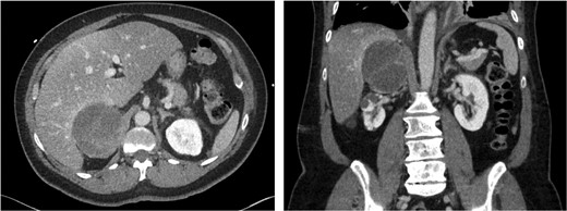Computed tomography scan images: axial and coronal views of the right adrenal tumor.