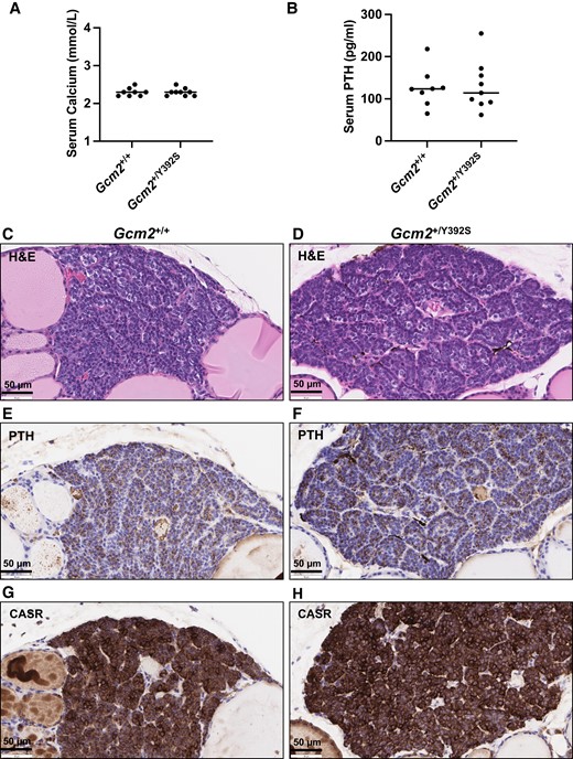 Knock-in mice with the Gcm2 variant p.Y392S show normal parathyroid gland associated features at age 24 months. (A and B) Calcium and parathyroid hormone (PTH) assay. Serum from Gcm2+/+ (n = 8) and Gcm2+/Y392S (n = 9) mice at age 24 months was used for measuring the circulating calcium and PTH levels. Both Gcm2+/+ and Gcm2+/Y392S mice show normal levels of calcium and PTH. (C-H) Representative brightfield microscopy images of parathyroid gland morphology. Serial sections of Gcm2+/+ and Gcm2+/Y392S parathyroid glands at age 24 months showing hematoxylin and eosin (H&E) staining, and immunohistochemistry with anti-PTH and anti-CASR. H&E staining showed similar histology of Gcm2+/+ and Gcm2+/Y392S (C and D), PTH staining was similar in the cytoplasm (brown) of Gcm2+/+ and Gcm2+/Y392S (E and F), and CASR staining was similar in the cell membrane (brown) of Gcm2+/+ and Gcm2+/Y392S (G and H). Blue color is from nuclear hematoxylin counter stain.