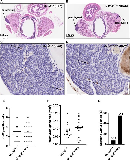 Knock-in mice with the Gcm2 variant p.Y392S show normal parathyroid cell proliferation. (A-D) Representative brightfield microscopy images of H&E and Ki-67 staining. Serial sections of Gcm2+/+ and Gcm2+/Y392S parathyroid glands at age 24 months showing hematoxylin and eosin (H&E) staining (low power), and immunohistochemistry with anti-Ki-67 (high power). Gcm2+/+ (A and C) and Gcm2+/Y392S (B and D) show similar parathyroid glands and similar Ki-67 staining (arrows pointing to Ki-67 positive cells with a brown nucleus). Blue color in C and D is from nuclear hematoxylin counter stain. (E) Parathyroid gland cell proliferation. To assess the level of cell proliferation, Ki-67 positive cells were counted from parathyroid tissue sections processed for anti-Ki-67 IHC as shown in C and D using 17 parathyroid glands each of Gcm2+/+ and Gcm2+/Y392S mice at age 18-24 months. All Ki-67 positive cells were counted in the entire parathyroid gland in the section. Similar number of Ki-67 positive cells were observed in Gcm2+/+ and Gcm2+/Y392S parathyroid glands indicating that the Gcm2+/Y392S parathyroid glands did not show increased cell proliferation. (F) Parathyroid gland area. Parathyroid gland size was measured from digital images of H&E-stained sections of 17 parathyroid glands from 14 Gcm2+/+ mice and 17 parathyroid glands from 11 Gcm2+/Y392S mice at age 18-24 months. Using the built-in scale of the Histoserv digital software, the length and breadth of the parathyroid glands were recorded in µm, and the area was calculated (length × breadth) in µm2 (converted to mm2, 1 µm2 = 10−6 mm2). Overall, Gcm2+/+ and Gcm2+/Y392S mice showed parathyroid glands of similar size. (G) Number of parathyroid glands per section. The number of parathyroid glands in H&E-stained sections of tracheal blocks from 14 Gcm2+/+ mice and 11 Gcm2+/Y392S mice at age 18-24 months was recorded. The occurrence of 2 glands per section for Gcm2+/Y392S mice was higher (55%) compared to Gcm2+/+ mice (21%).