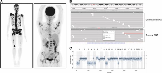 Clinical and tumor molecular characteristics of the patient harboring multiple somatic monosomy. (A) Bone scan and 18F-FDG PET/CT showing multiple lytic lesions involving the skull, and axial and appendicular skeleton. (B) Result of NGS showing absence of RET germinative mutation and presence of a somatic M918T mutation. (C) Somatic copy number alteration analysis (SCNA) with losses of chromosomes 1p, 3, 4, 5, 9, and 13.