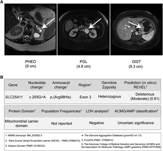 (A) Magnetic resonance images of a patient with Carney-Stratakis syndrome. Axial T2-weighted magnetic resonance imaging (MRI) shows a left solid-cystic pheochromocytoma (PHEO; white arrow), an axial T2-weighted MRI depicts a para-aortic paraganglioma (PGL; white arrow), and MRI scans illustrate a gastrointestinal stromal tumor (GIST; white arrow) originating from the gastric body and fundus. (B) Whole-exome sequencing results reveal a key germline variant in the DNA of the patient with CSS.