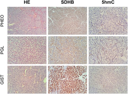 Immunohistochemical analysis of SDHB and 5-hydroxymethylcytosine (5hmC) in tumor samples from a patient with Carney-Stratakis syndrome, including pheochromocytoma (PHEO), paraganglioma (PGL), and gastrointestinal stromal tumors (GIST). The samples were stained with hematoxylin and eosin (HE), and images were captured at a magnification of 400×.
