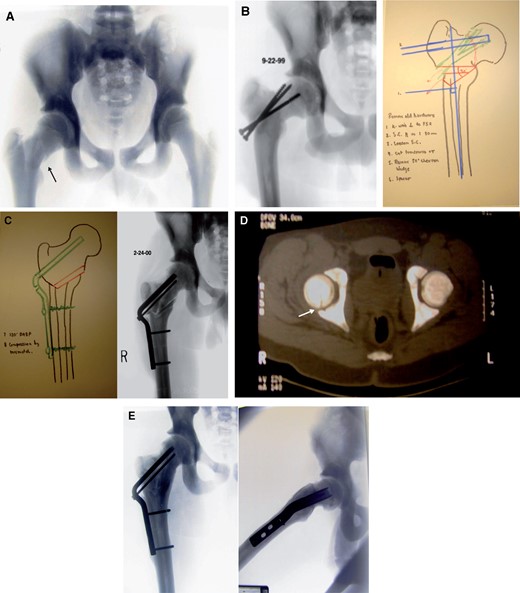 Intertrochanteric valgus osteotomy for neck non-union. (A) A 15-year-old male with a mildly displaced medio-cervical fracture of the right femoral neck after low velocity trauma (arrow). (B) Varus tilt and non-union 10 months after screw fixation. The screws are migrating out of the proximal fragment but their direction is indicative of suboptimal insertion. First phase of planning with a seating chissel in place for 30° valgus correction using a 120° double angle blade plate. An 80-mm blade length should cross the non-union. A 30° wedge resection is mentioned. An additional 15° flexion to compensate for the retrotilt is not visible.in this plane. (C) Second planning paper shows the end result which incorporates full angular correction and leg length. The double line represents the osseous wedge placed into the posterior gap resulting from the flexion of the proximal fragment. The achieved correction has led to identical contours. The blade length is 10mm shorter, which allowed closure of the head split produced by the fully introduced seating chisel. (D) Postoperative computer tomography confirms the almost complete closure of the head split fracture (arrow). (E) Anteroposterior and lateral radiographies 2 years after osteotomy reveal complete healing of the non-union and osteotomy with a round head and large joint space without signs of necrosis. Small circumferential osteophytes may be a complication of the head split.